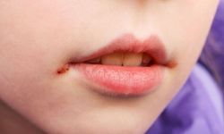 Dudakta Uçuk Neden Çıkar? Nasıl Geçer?