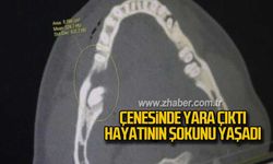 Çenesinde yara çıktı hayatının şokunu yaşadı