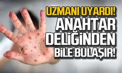 Uzmanı uyardı... Kızamık anahtar deliğinden bile bulaşır!