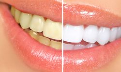 Diş Beyazlatma Kalıcı Mıdır?