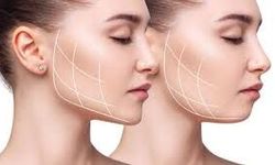Yüz Estetiği ve Çene Sağlığı Arasında Masseter Botoks Uygulaması