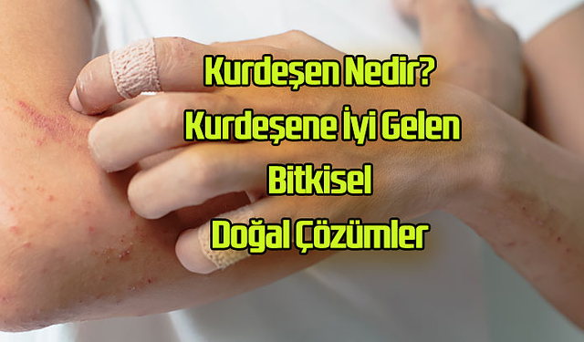 Kurdeşen Nedir? Kurdeşene İyi Gelen Bitkisel Doğal Çözümler