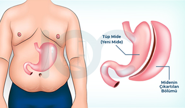 Tüp Mide Ameliyatı Nedir?
