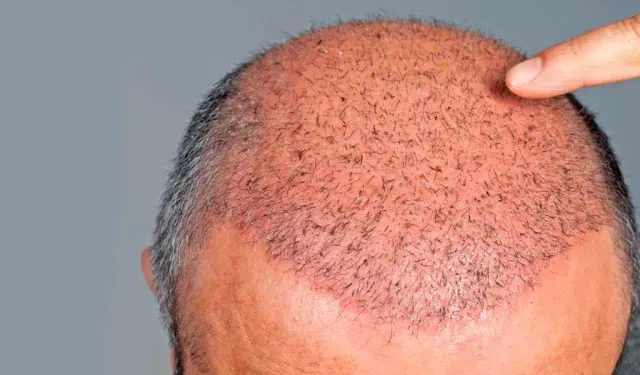 En iyi 10 saç ekimi kliniği: Karar Vermeden Önce Okunacak Rehber