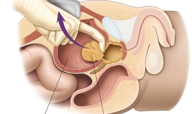 Prostat Büyümesi Nedir? Ne Zaman Ameliyat Gerekir?